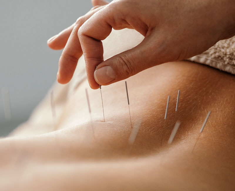 Acupuncture